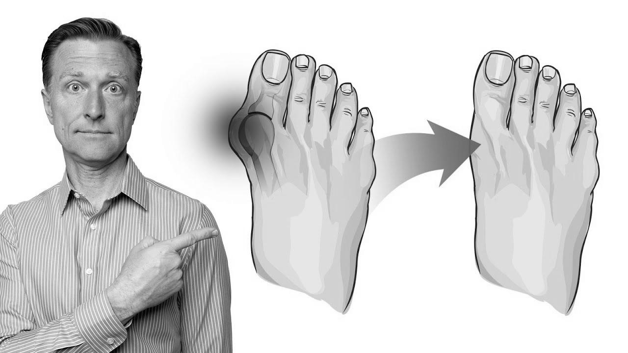 The way to Fix Bunions in 3 Steps